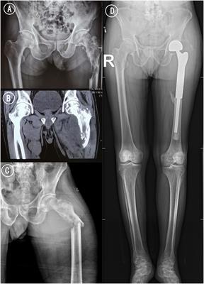 Case report: Sintilimab combined with anlotinib as neoadjuvant chemotherapy for metastatic bone tumor resection in patients with PSC